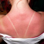 sunburn, sun burn, tan lines