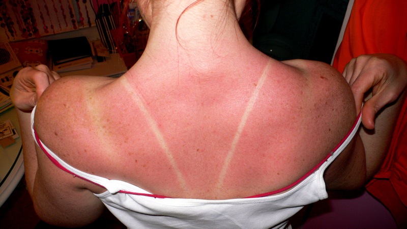 sunburn, sun burn, tan lines